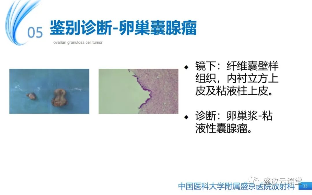 影像PPT - 【PPT】卵巢颗粒细胞瘤-32