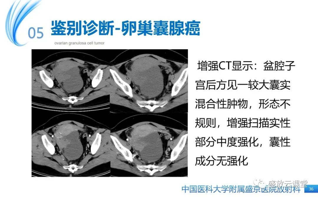 影像PPT - 【PPT】卵巢颗粒细胞瘤-35