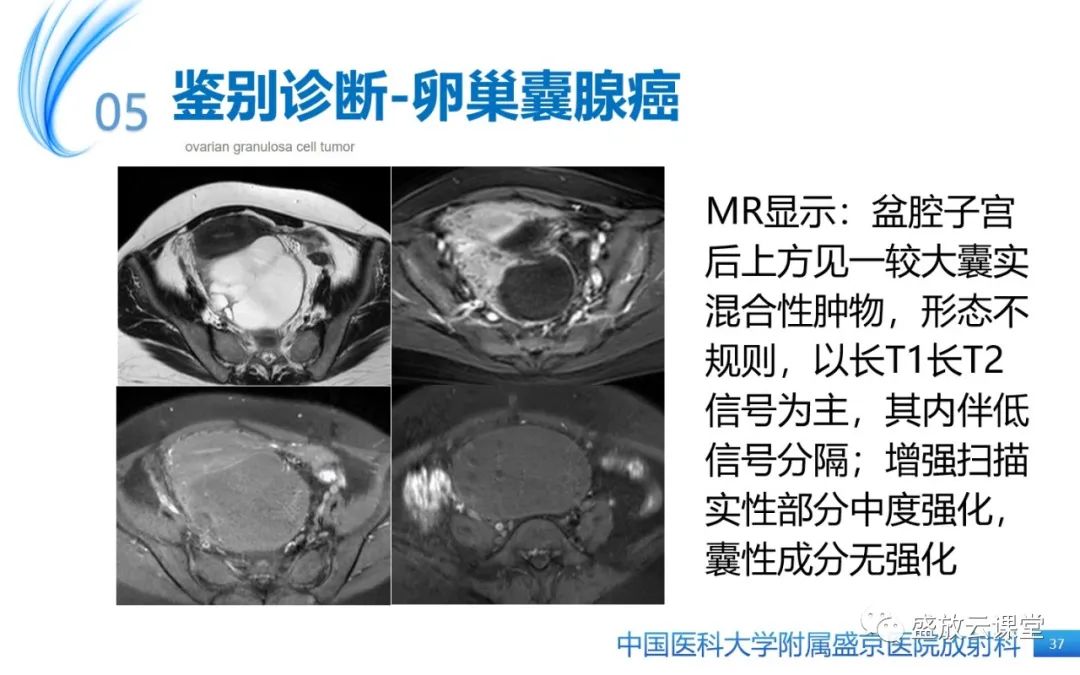 影像PPT - 【PPT】卵巢颗粒细胞瘤-36