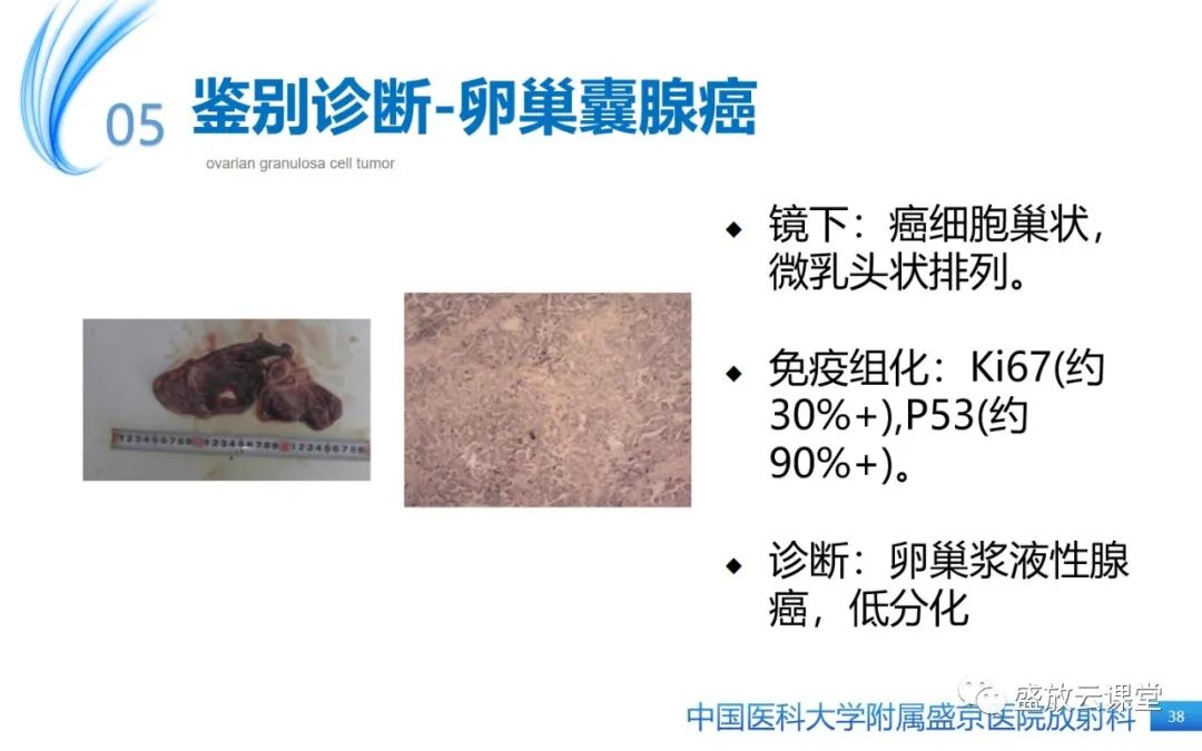 影像PPT - 【PPT】卵巢颗粒细胞瘤-37