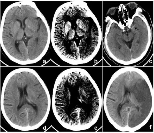 影像PPT - 急性脑梗死 CT MRI读片要点-1 影像PPT - 急性脑梗死 CT MRI读片要点-1