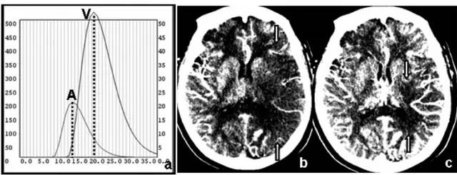 影像PPT - 急性脑梗死 CT MRI读片要点-3 影像PPT - 急性脑梗死 CT MRI读片要点-3