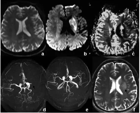 影像PPT - 急性脑梗死 CT MRI读片要点-6 影像PPT - 急性脑梗死 CT MRI读片要点-6