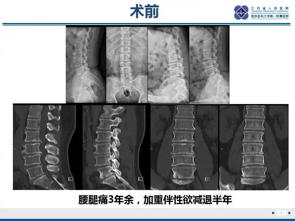 影像PPT - 【PPT】椎间融合器沉降-3