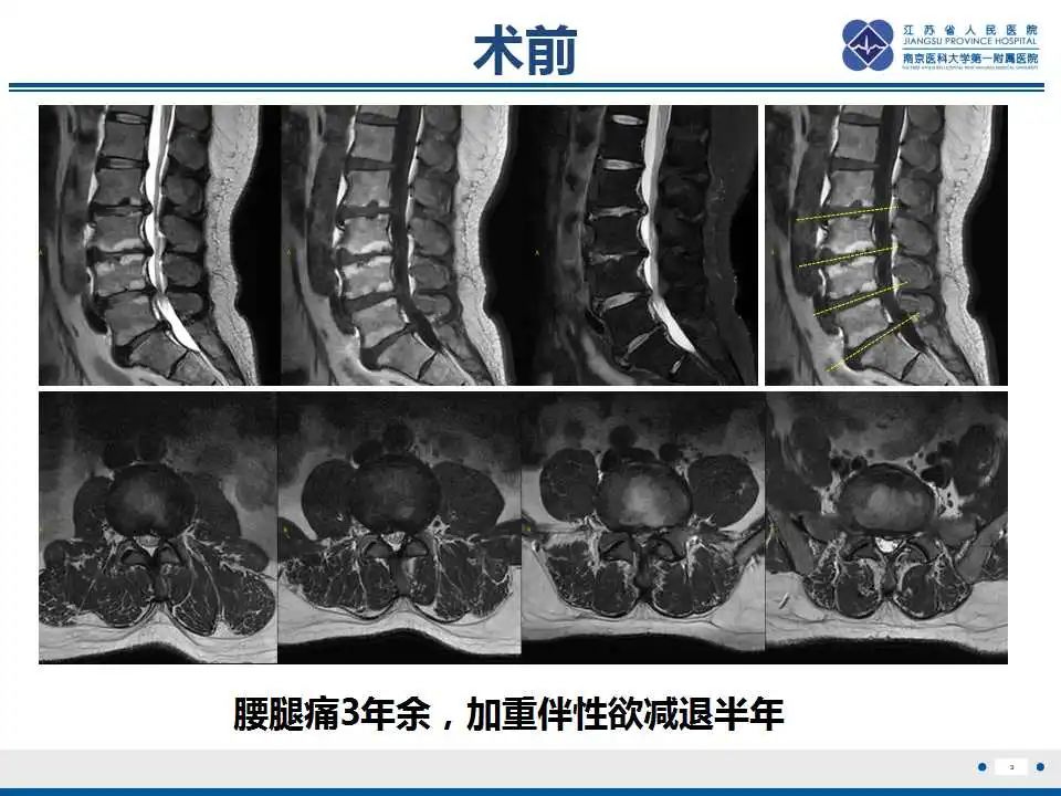 影像PPT - 【PPT】椎间融合器沉降-4