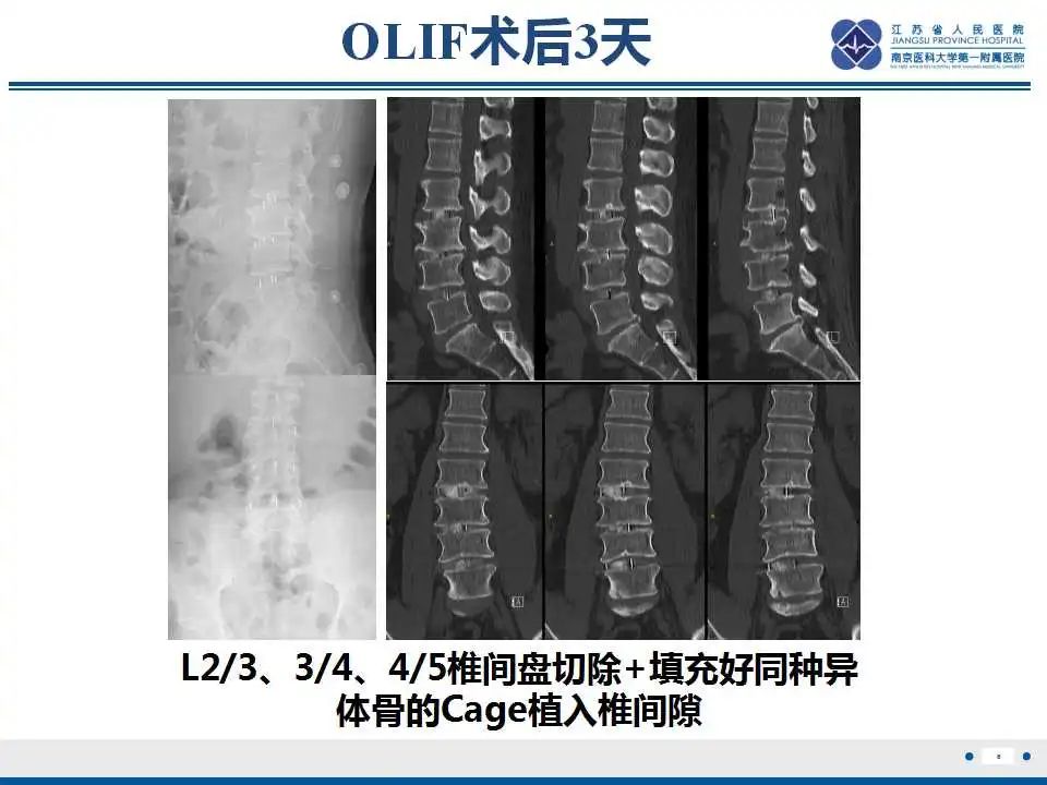 影像PPT - 【PPT】椎间融合器沉降-7