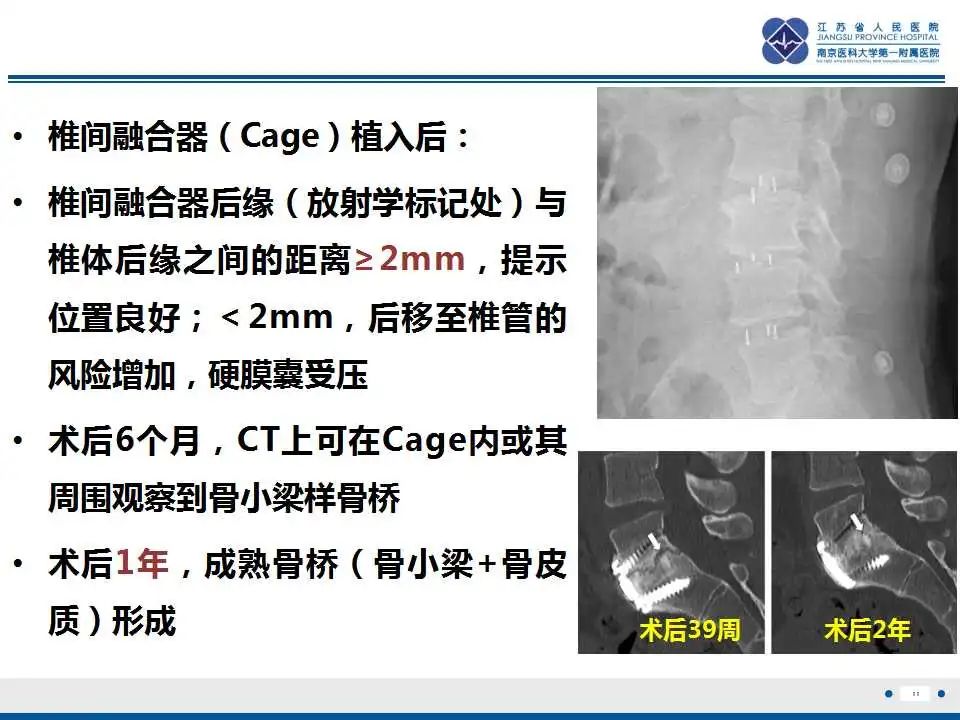 影像PPT - 【PPT】椎间融合器沉降-12