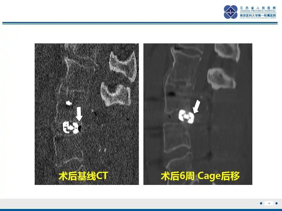 影像PPT - 【PPT】椎间融合器沉降-13