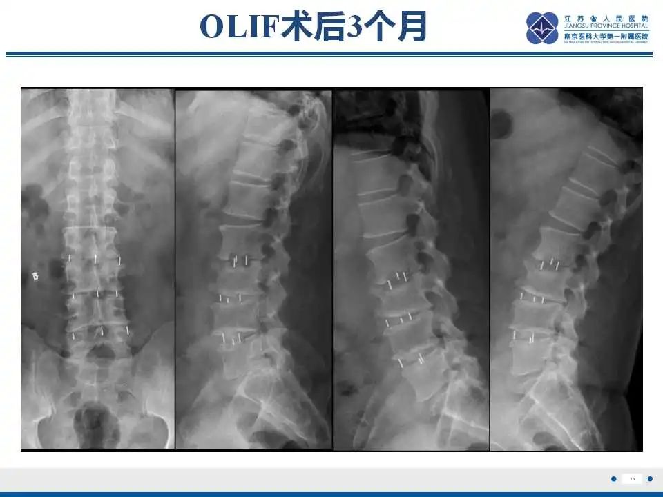 影像PPT - 【PPT】椎间融合器沉降-14