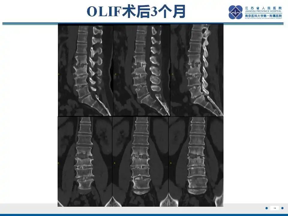 影像PPT - 【PPT】椎间融合器沉降-15