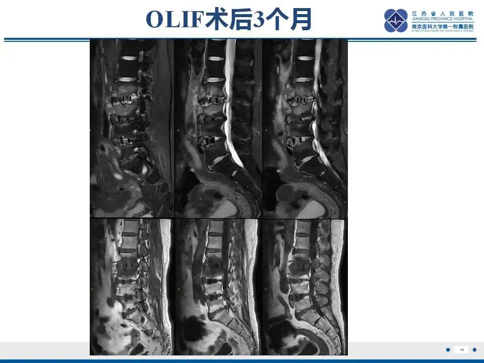 影像PPT - 【PPT】椎间融合器沉降-16