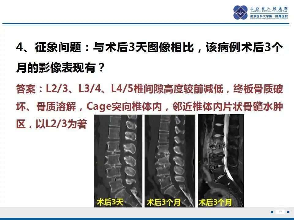 影像PPT - 【PPT】椎间融合器沉降-18