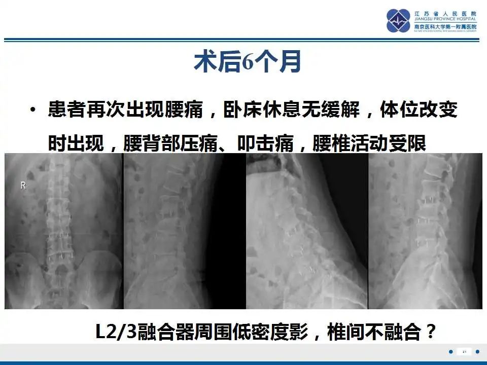 影像PPT - 【PPT】椎间融合器沉降-22