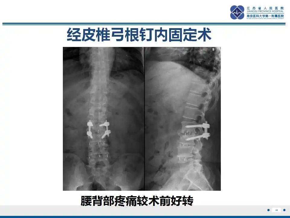 影像PPT - 【PPT】椎间融合器沉降-23