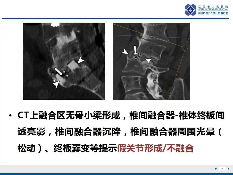 影像PPT - 【PPT】椎间融合器沉降-26