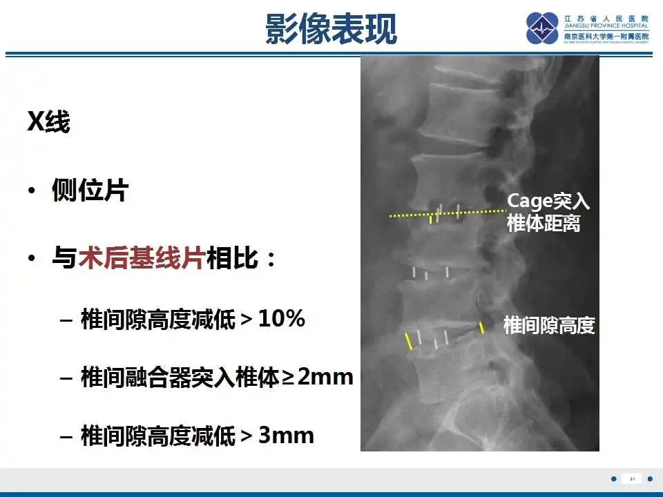 影像PPT - 【PPT】椎间融合器沉降-32