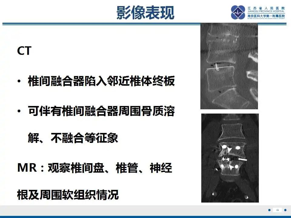 影像PPT - 【PPT】椎间融合器沉降-34