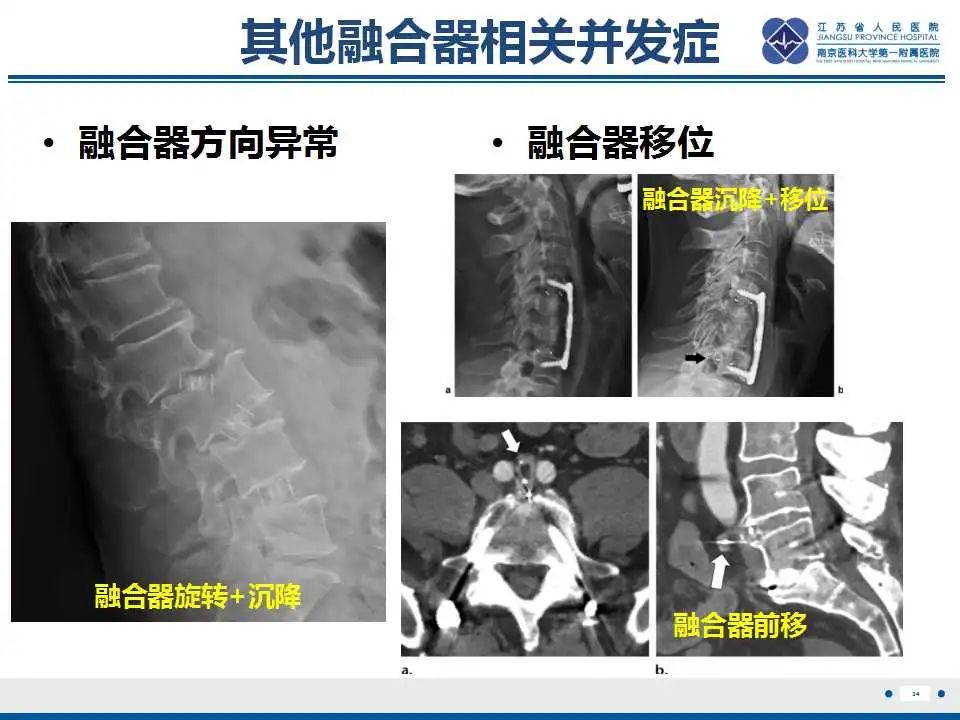 影像PPT - 【PPT】椎间融合器沉降-35