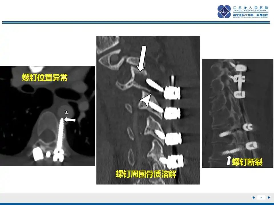 影像PPT - 【PPT】椎间融合器沉降-37