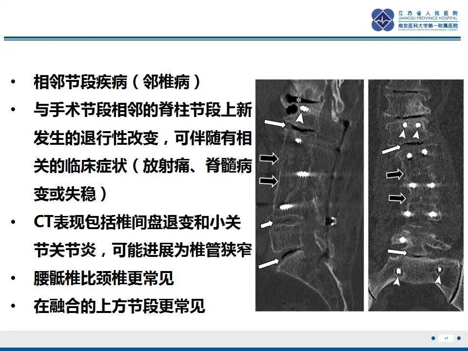 影像PPT - 【PPT】椎间融合器沉降-38