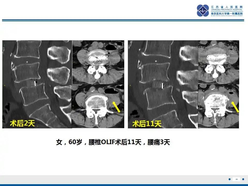 影像PPT - 【PPT】椎间融合器沉降-39