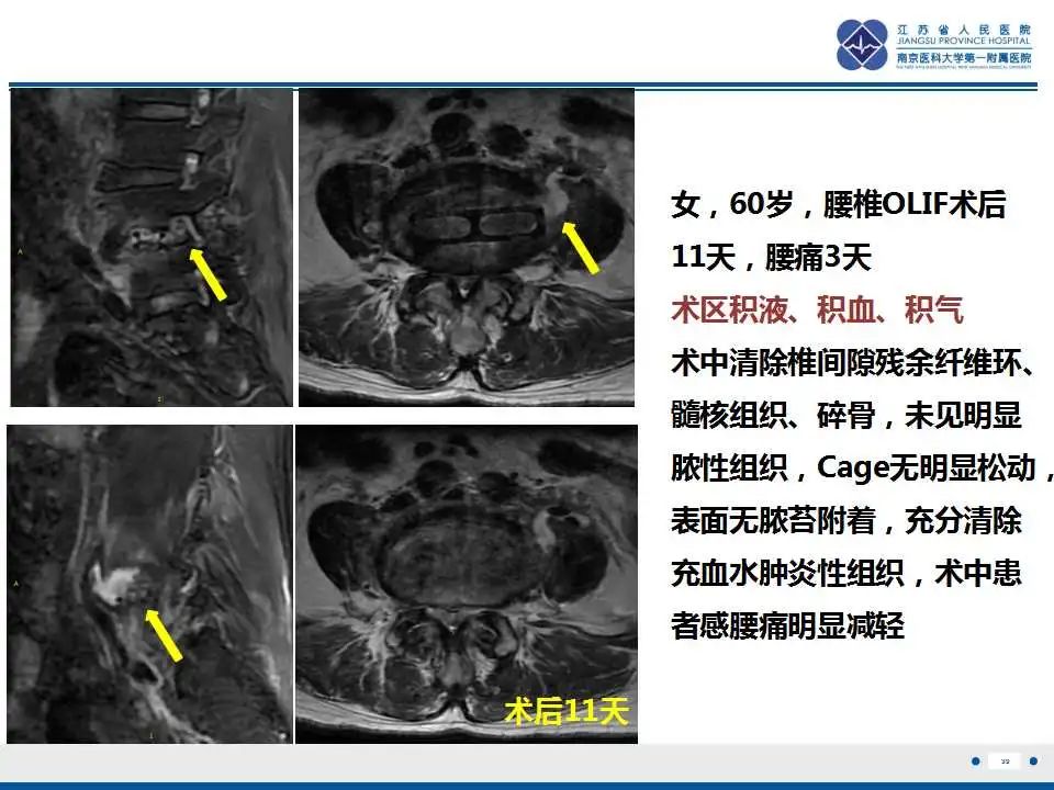 影像PPT - 【PPT】椎间融合器沉降-40