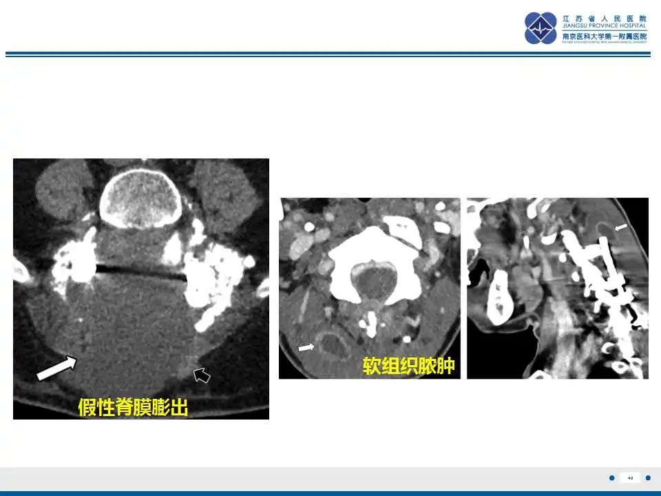 影像PPT - 【PPT】椎间融合器沉降-41