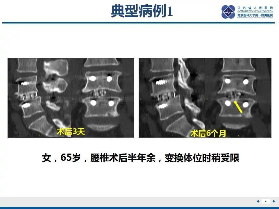 影像PPT - 【PPT】椎间融合器沉降-43