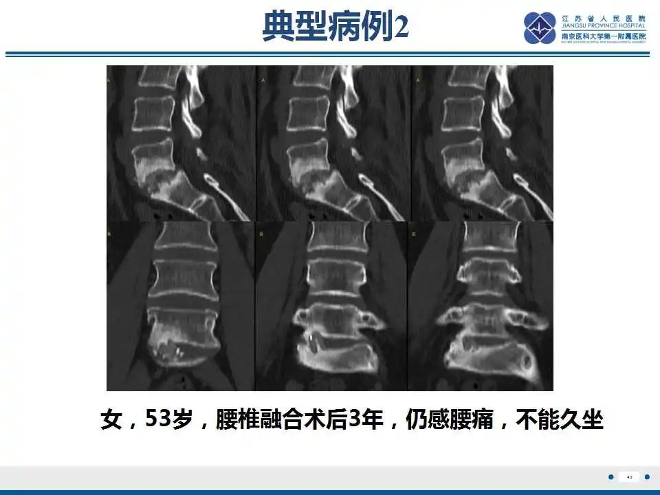 影像PPT - 【PPT】椎间融合器沉降-44