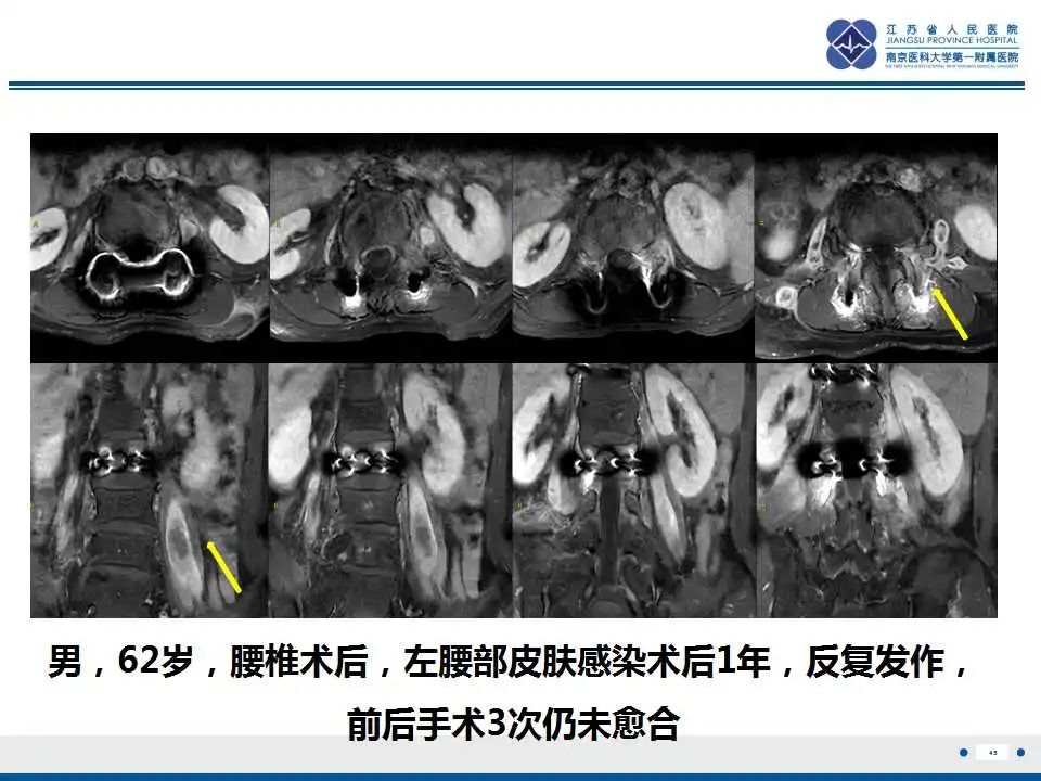 影像PPT - 【PPT】椎间融合器沉降-46