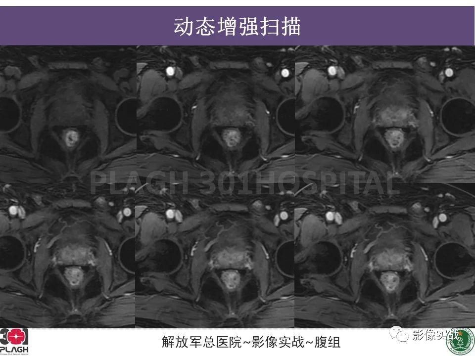 影像PPT - 【病例】前列腺癌PI-RADS评分1例MR-6