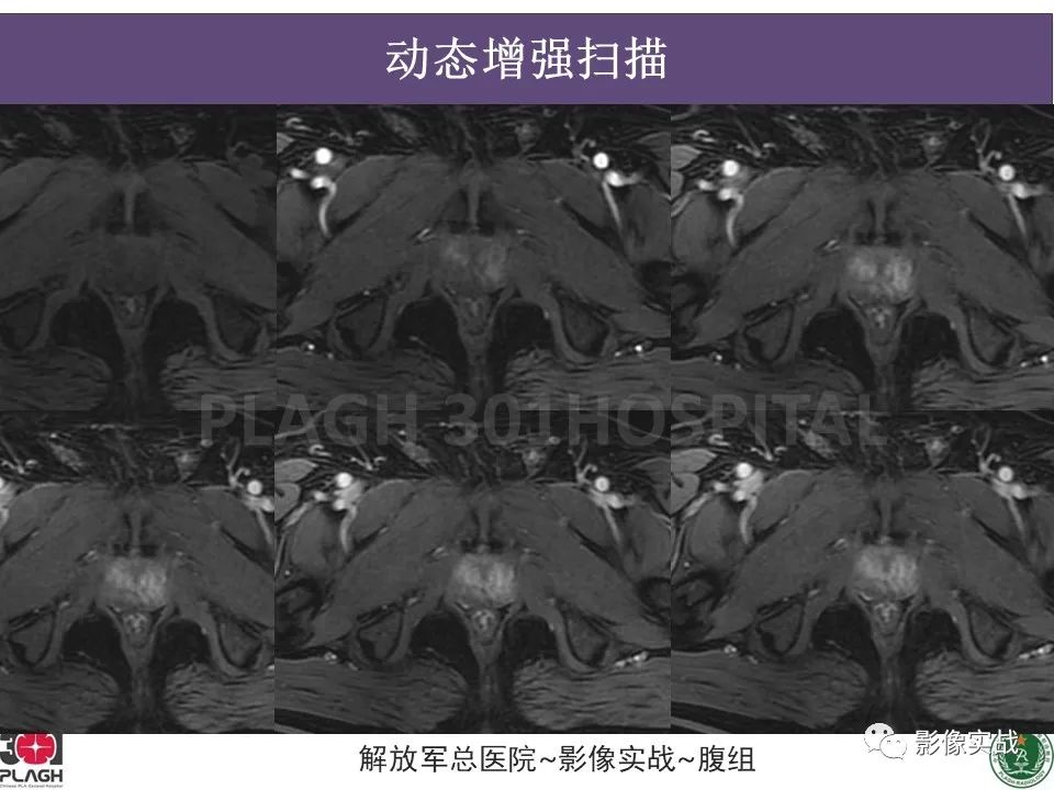 影像PPT - 【病例】前列腺癌PI-RADS评分1例MR-7