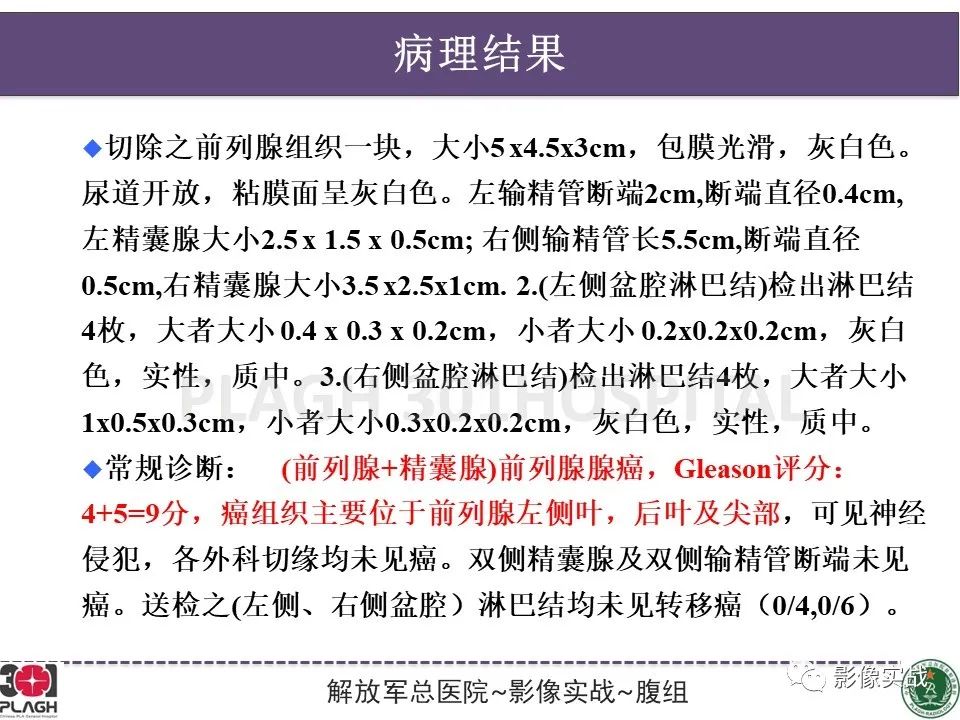影像PPT - 【病例】前列腺癌PI-RADS评分1例MR-16