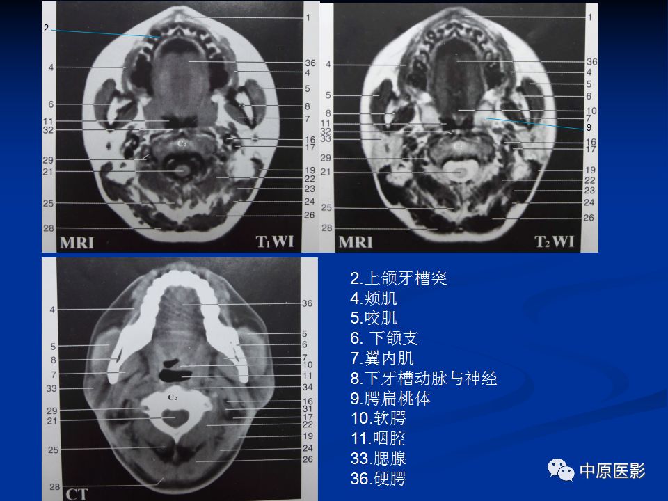 影像PPT - 【PPT】腭部常见肿瘤的影像诊断-5