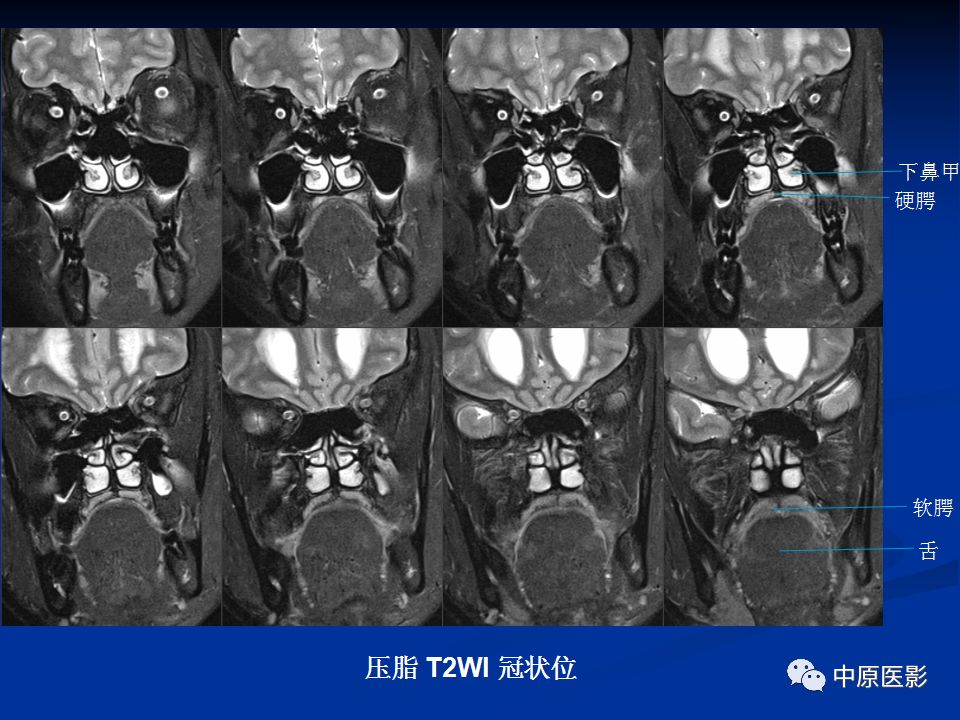 影像PPT - 【PPT】腭部常见肿瘤的影像诊断-8