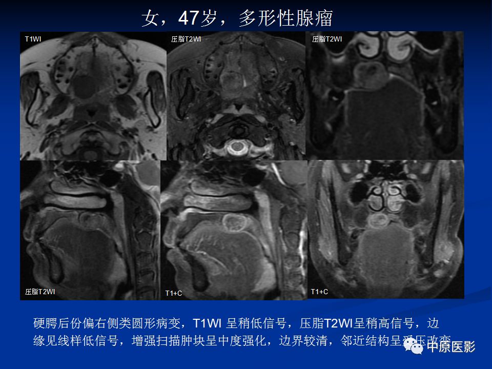 影像PPT - 【PPT】腭部常见肿瘤的影像诊断-15