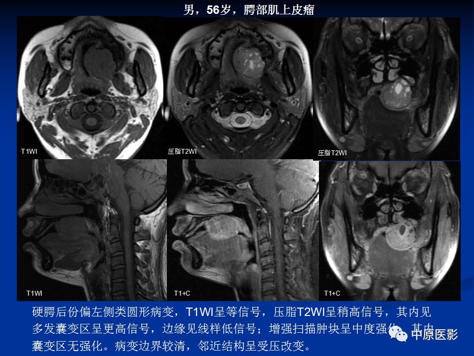 影像PPT - 【PPT】腭部常见肿瘤的影像诊断-18