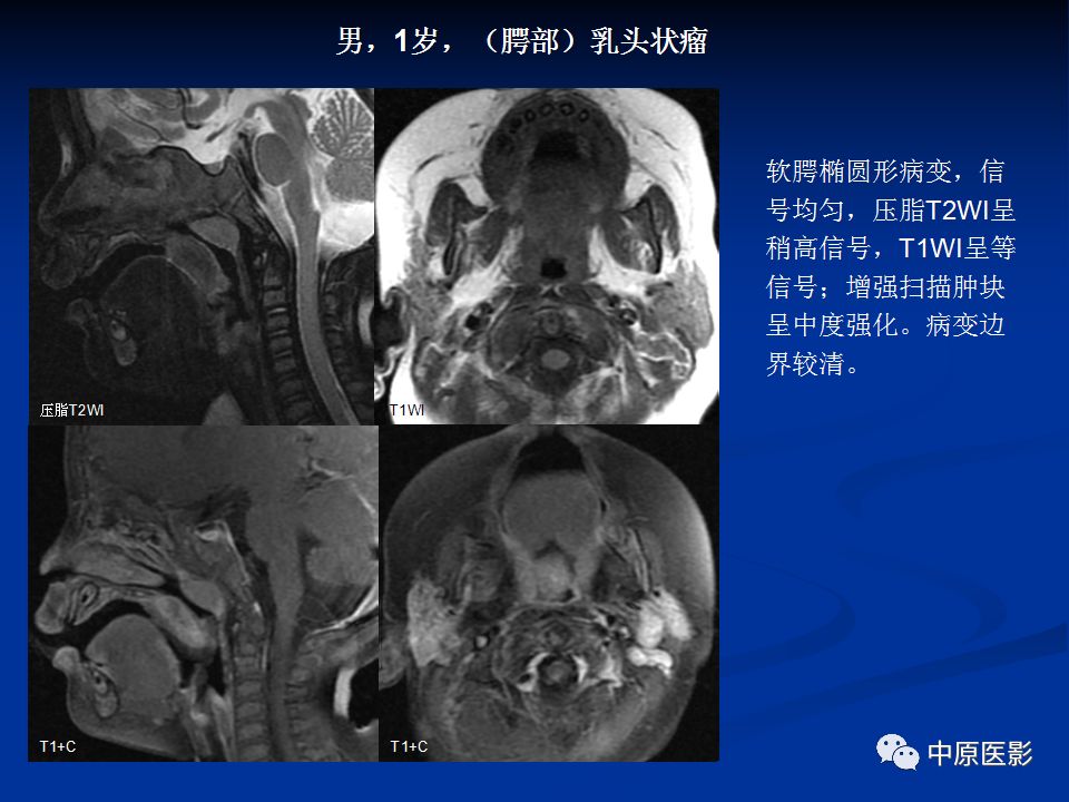 影像PPT - 【PPT】腭部常见肿瘤的影像诊断-21