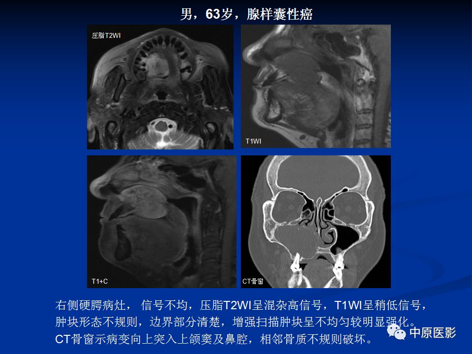影像PPT - 【PPT】腭部常见肿瘤的影像诊断-25