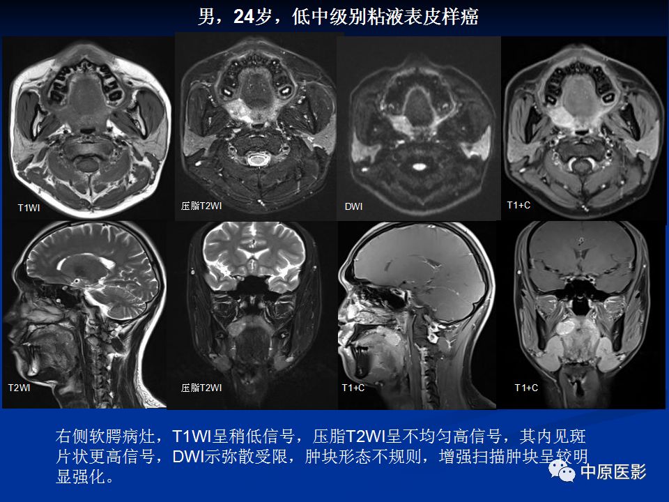 影像PPT - 【PPT】腭部常见肿瘤的影像诊断-28