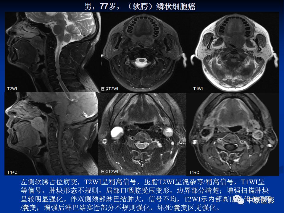 影像PPT - 【PPT】腭部常见肿瘤的影像诊断-31