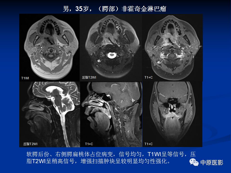 影像PPT - 【PPT】腭部常见肿瘤的影像诊断-34