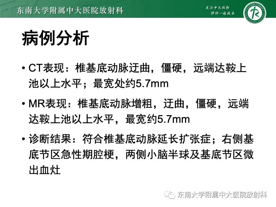 影像PPT - 【PPT】椎基底动脉延长扩张症-3