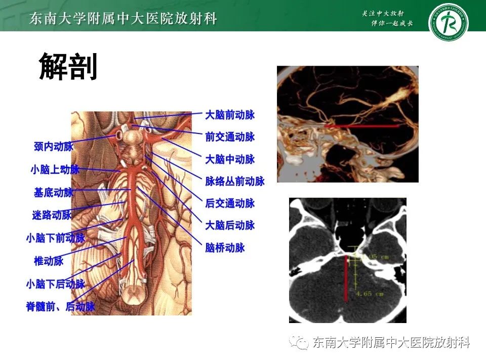 影像PPT - 【PPT】椎基底动脉延长扩张症-5