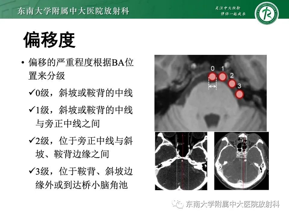 影像PPT - 【PPT】椎基底动脉延长扩张症-10