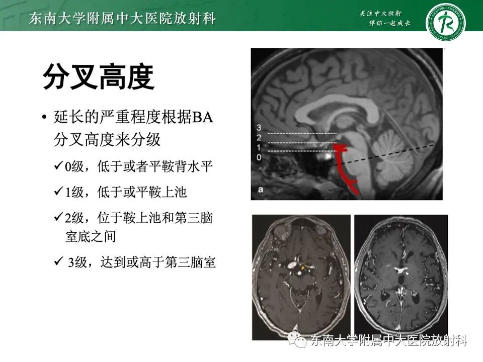 影像PPT - 【PPT】椎基底动脉延长扩张症-11