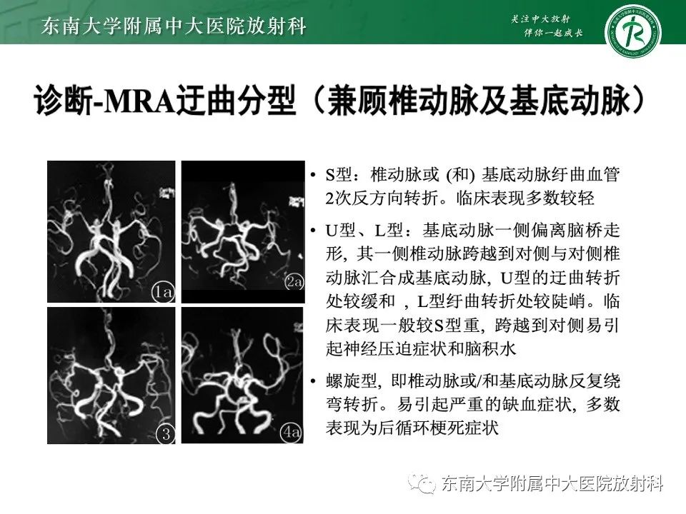 影像PPT - 【PPT】椎基底动脉延长扩张症-14