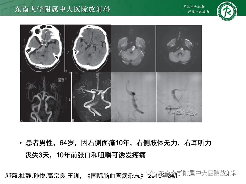 影像PPT - 【PPT】椎基底动脉延长扩张症-16