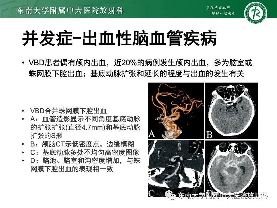 影像PPT - 【PPT】椎基底动脉延长扩张症-17