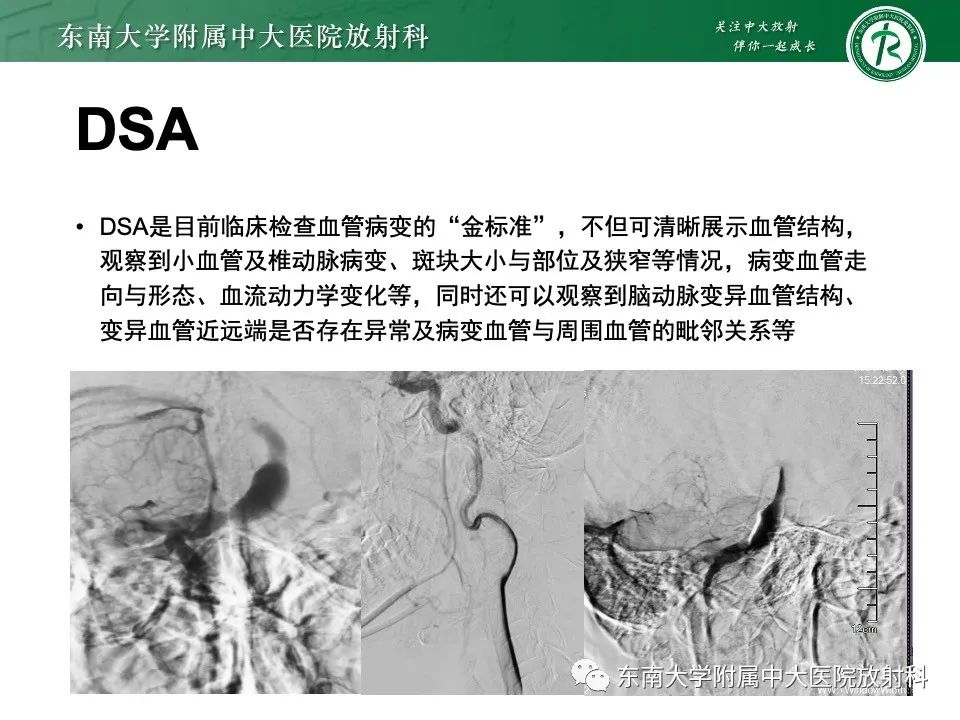 影像PPT - 【PPT】椎基底动脉延长扩张症-19